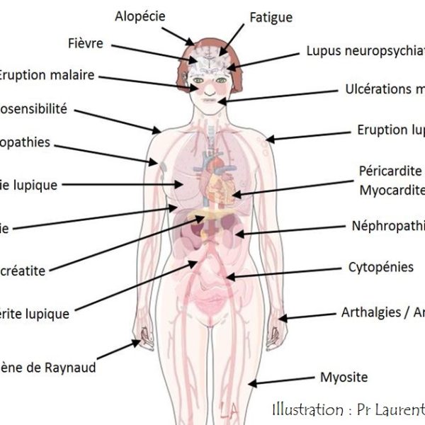 AUTO IMMUNITE ET ALLERGIES : Quand ton immunité devient le voisin relou du quartier